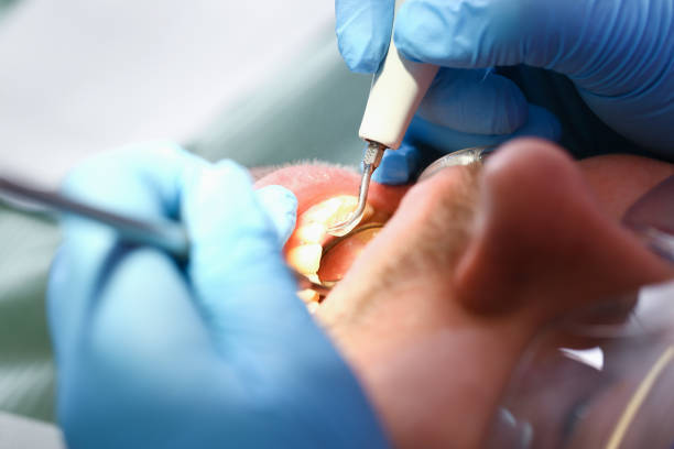 Best Emergency Dentist for Knocked-Out Tooth in Gaylord, MI
