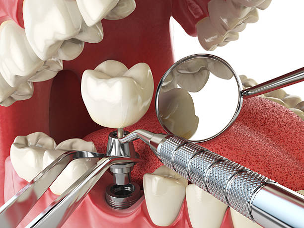 Best Emergency Dentist for Knocked-Out Tooth in Gaylord, MI
